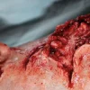 ForensicFX Studios Dog Bite Wound Prosthetic Outlet