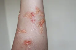 ForensicFX Studios Infected Blisters / Boils Prosthetic Cheap