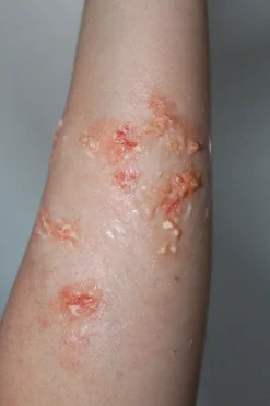 ForensicFX Studios Infected Blisters / Boils Prosthetic Cheap