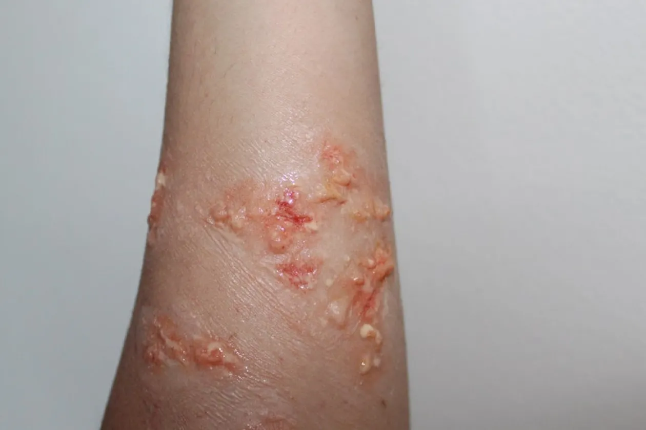 ForensicFX Studios Infected Blisters / Boils Prosthetic Cheap