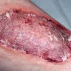 ForensicFX Studios Infected Medical Skin Graft Prosthetic Best Sale