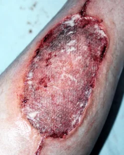 ForensicFX Studios Infected Medical Skin Graft Prosthetic Best Sale