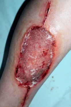 ForensicFX Studios Infected Medical Skin Graft Prosthetic Best Sale