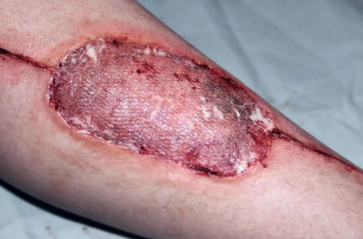 ForensicFX Studios Infected Medical Skin Graft Prosthetic Best Sale