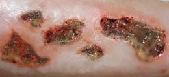 ForensicFX Studios Infected Wound / Burn Prosthetic Sale