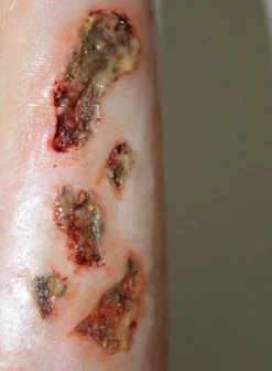 ForensicFX Studios Infected Wound / Burn Prosthetic Sale