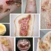 ForensicFX Studios Infected/Burn Wound Prosthetics Bundle Clearance