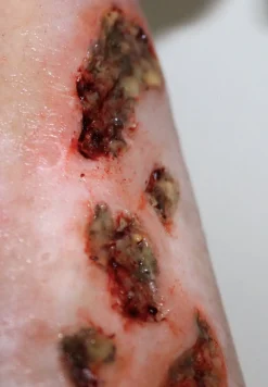 ForensicFX Studios Infected/Burn Wound Prosthetics Bundle Clearance