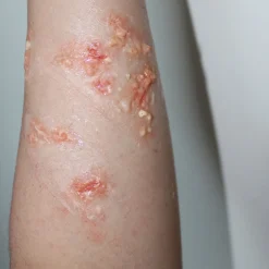 ForensicFX Studios Infected/Burn Wound Prosthetics Bundle Clearance