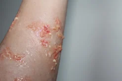 ForensicFX Studios Infected/Burn Wound Prosthetics Bundle Clearance