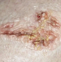 ForensicFX Studios Infected/Burn Wound Prosthetics Bundle Clearance