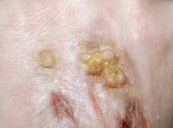 ForensicFX Studios Infected/Burn Wound Prosthetics Bundle Clearance