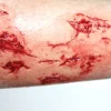 ForensicFX Studios Irregular Wound Lacerations Prosthetic Best Sale