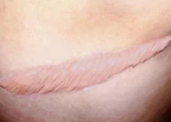 ForensicFX Studios Large Healed Keloid Scar Flash Sale