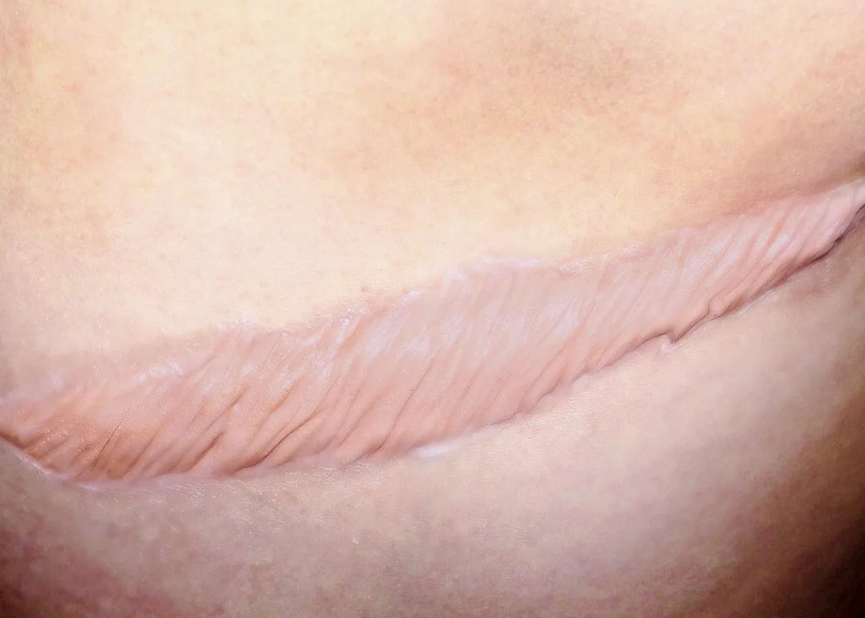 ForensicFX Studios Large Healed Keloid Scar Flash Sale