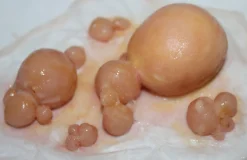 ForensicFX Studios Large Infected Boils Prosthetic Discount