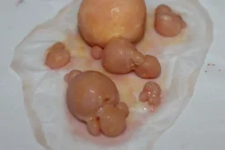 ForensicFX Studios Large Infected Boils Prosthetic Discount