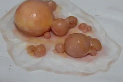 ForensicFX Studios Large Infected Boils Prosthetic Discount