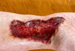 ForensicFX Studios Skin Burn Prosthetic Online