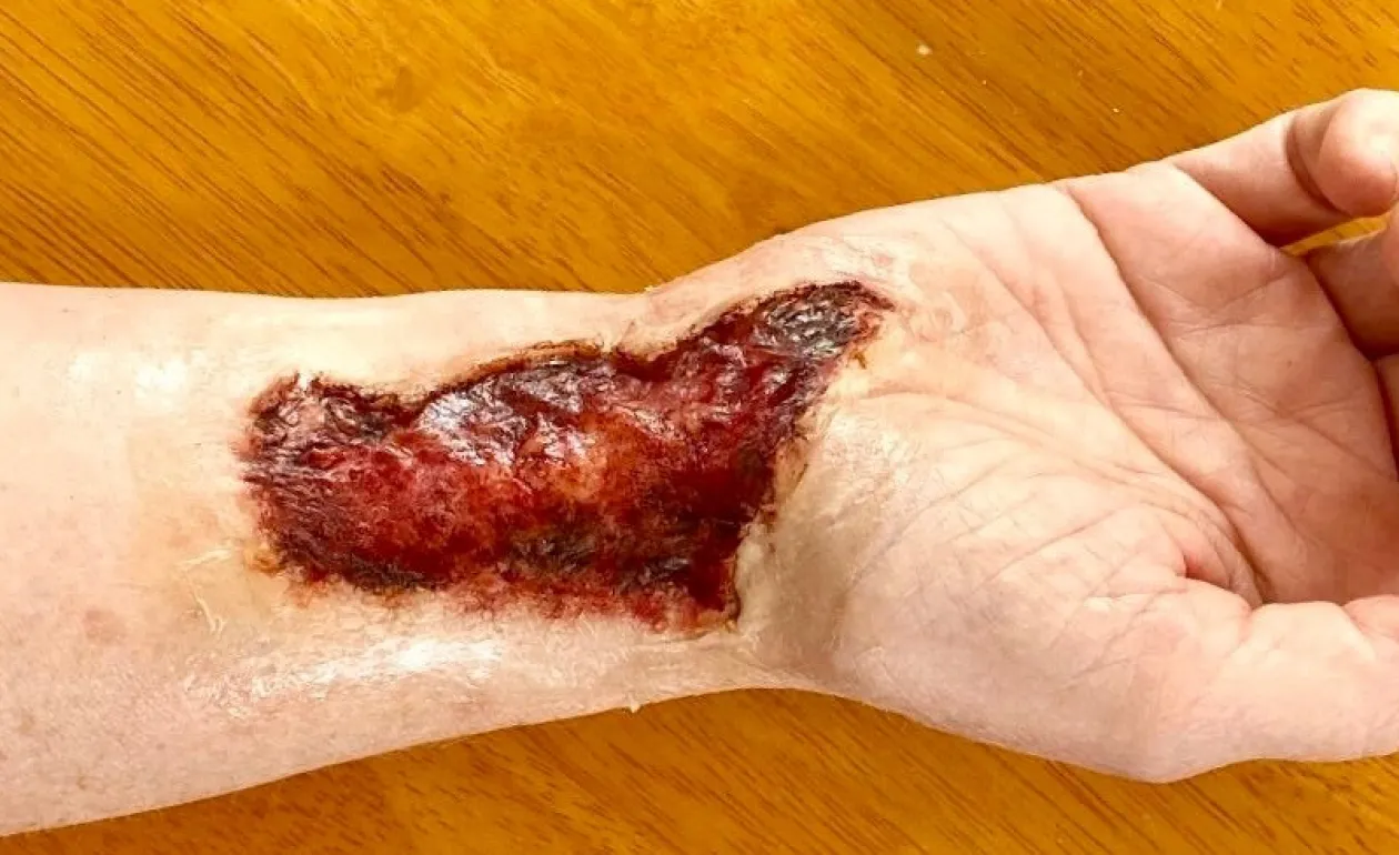ForensicFX Studios Skin Burn Prosthetic Online