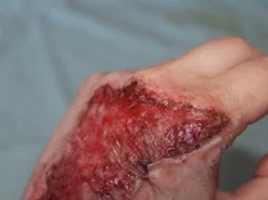 ForensicFX Studios Skin Burn Prosthetic Online