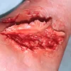 ForensicFX Studios Skin Peeling Back Wound Prosthetic Cheap