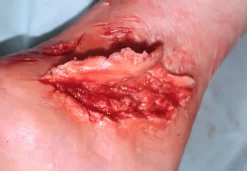 ForensicFX Studios Skin Peeling Back Wound Prosthetic Cheap