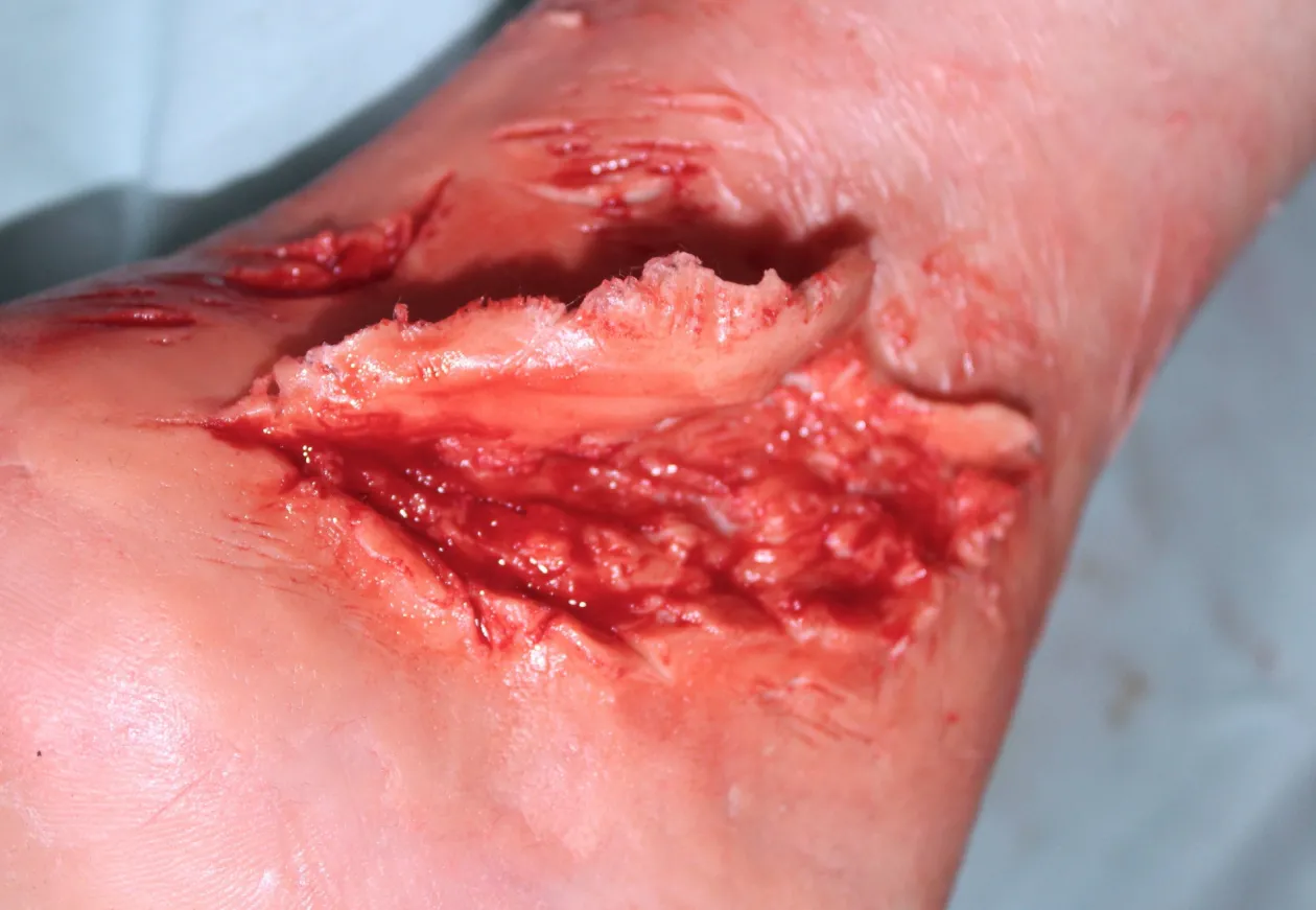 ForensicFX Studios Skin Peeling Back Wound Prosthetic Cheap