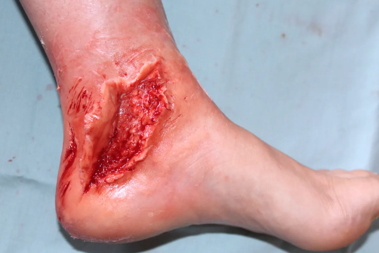 ForensicFX Studios Skin Peeling Back Wound Prosthetic Cheap