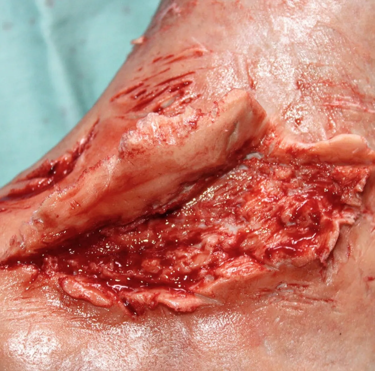 ForensicFX Studios Skin Peeling Back Wound Prosthetic Cheap